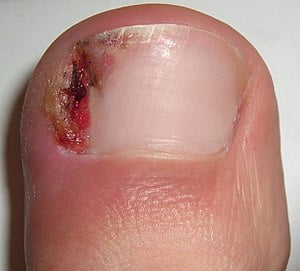 Ingrown nail treatment